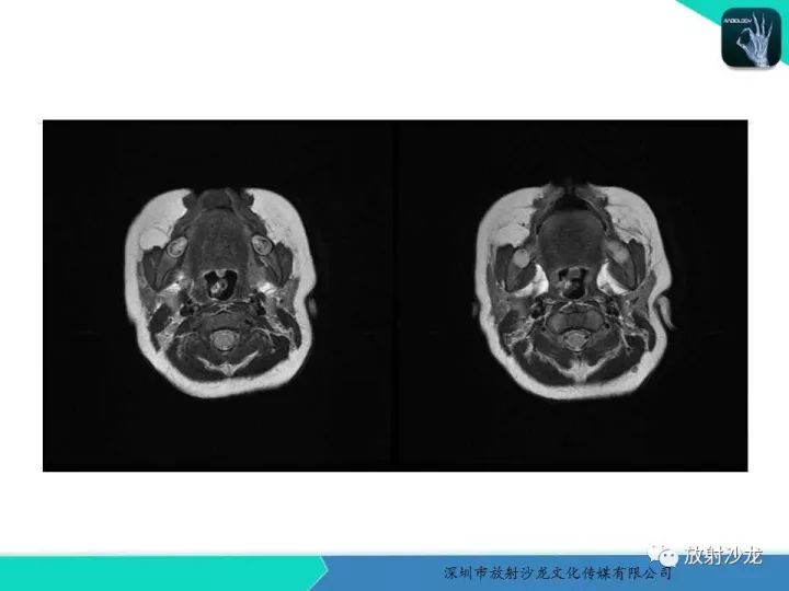 【病例】咽部畸胎瘤1例MR影像表现