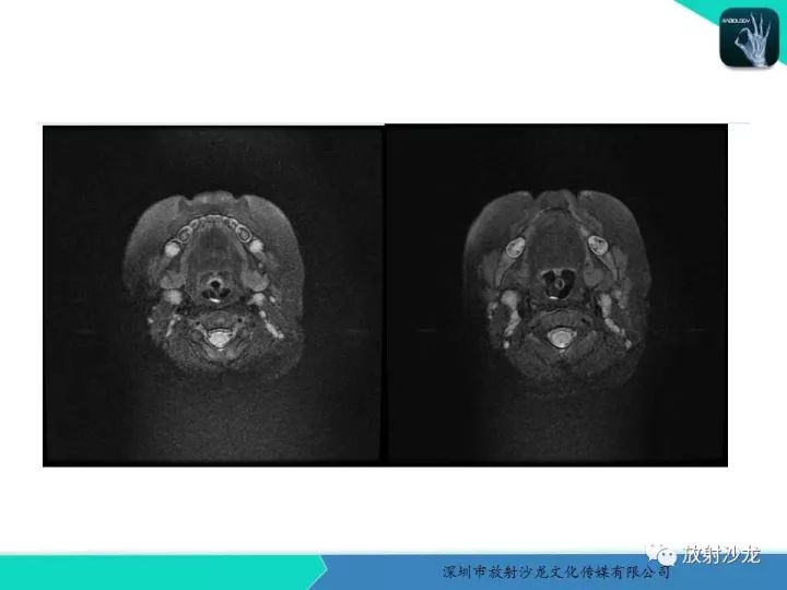 【病例】咽部畸胎瘤1例MR影像表现
