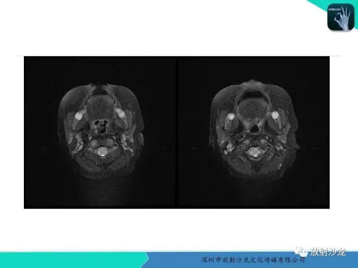 【病例】咽部畸胎瘤1例MR影像表现