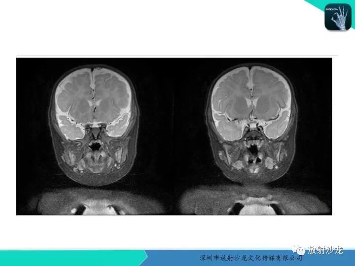 【病例】咽部畸胎瘤1例MR影像表现