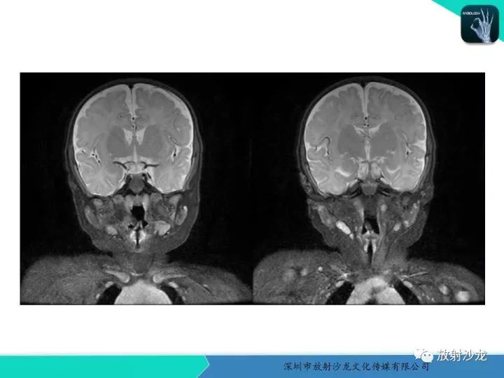 【病例】咽部畸胎瘤1例MR影像表现