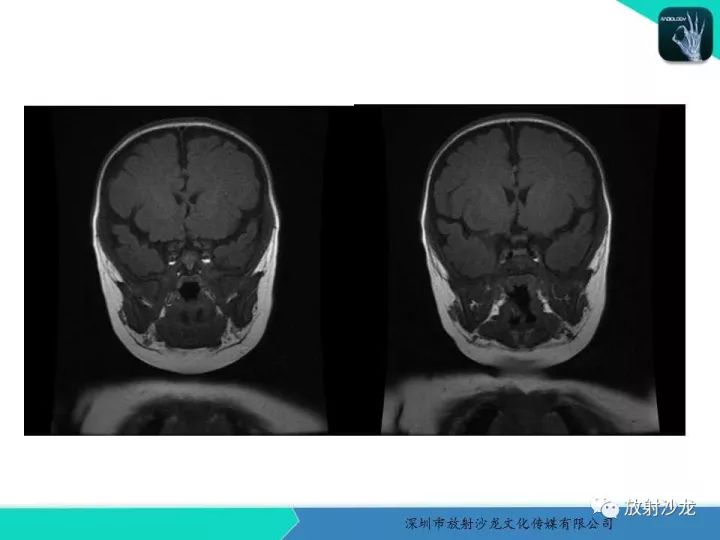 【病例】咽部畸胎瘤1例MR影像表现