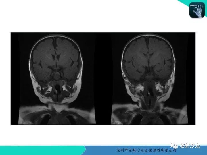 【病例】咽部畸胎瘤1例MR影像表现