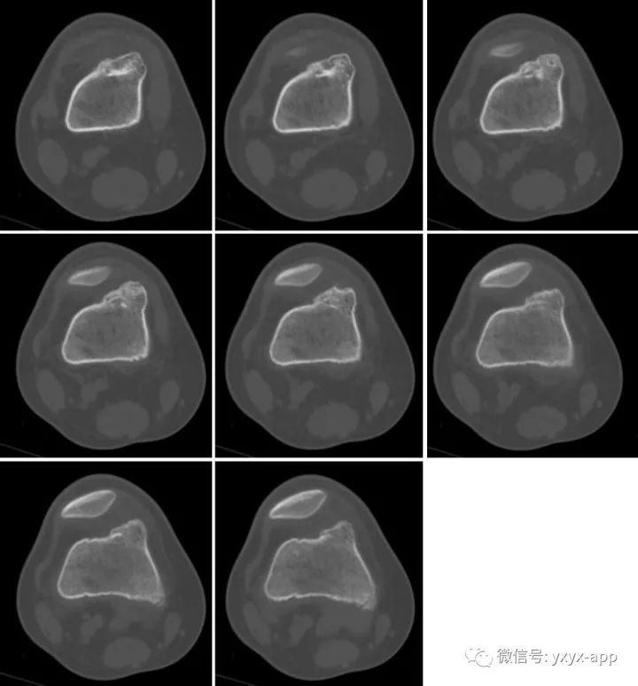 【病例】骨膜软骨瘤1例X线CT影像表现