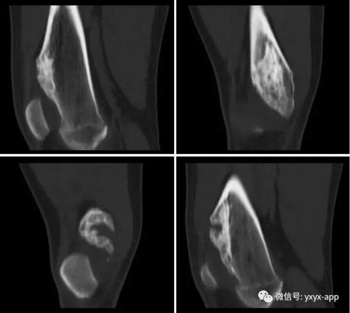 【病例】骨膜软骨瘤1例X线CT影像表现