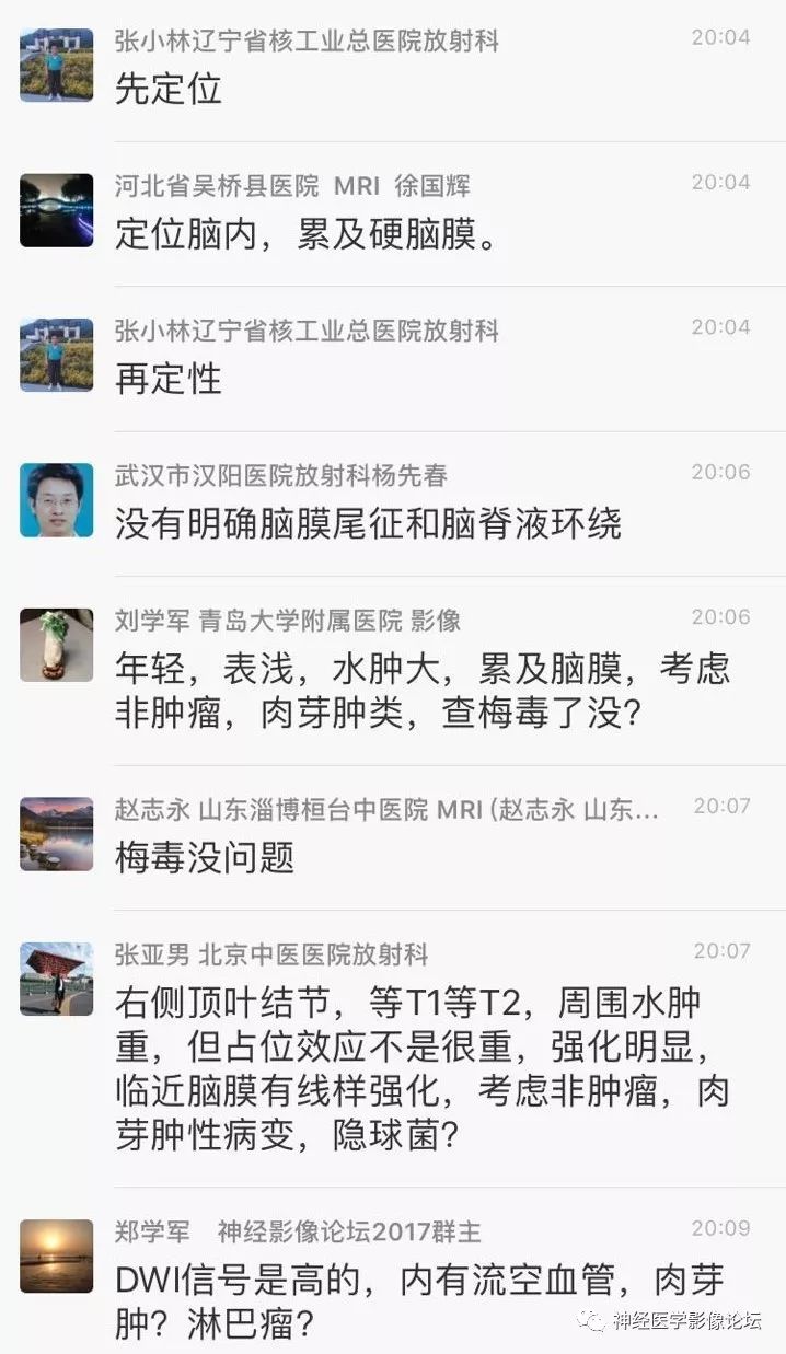【病例】靠近脑表累及脑膜室管膜瘤1例MR