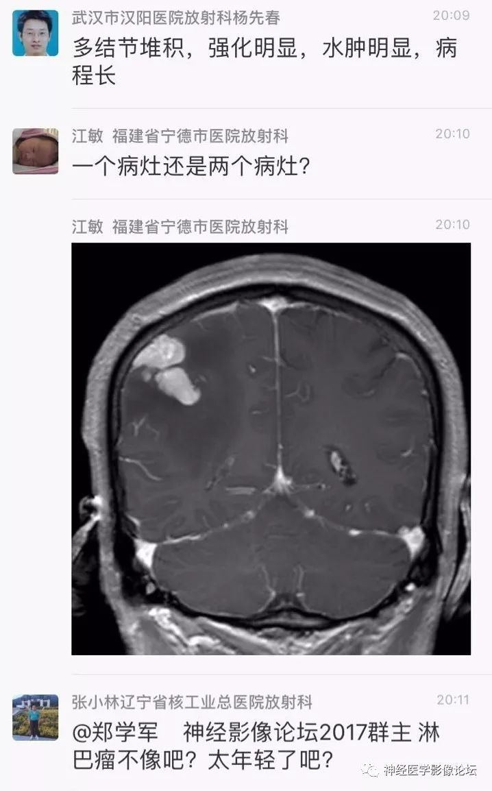 【病例】靠近脑表累及脑膜室管膜瘤1例MR