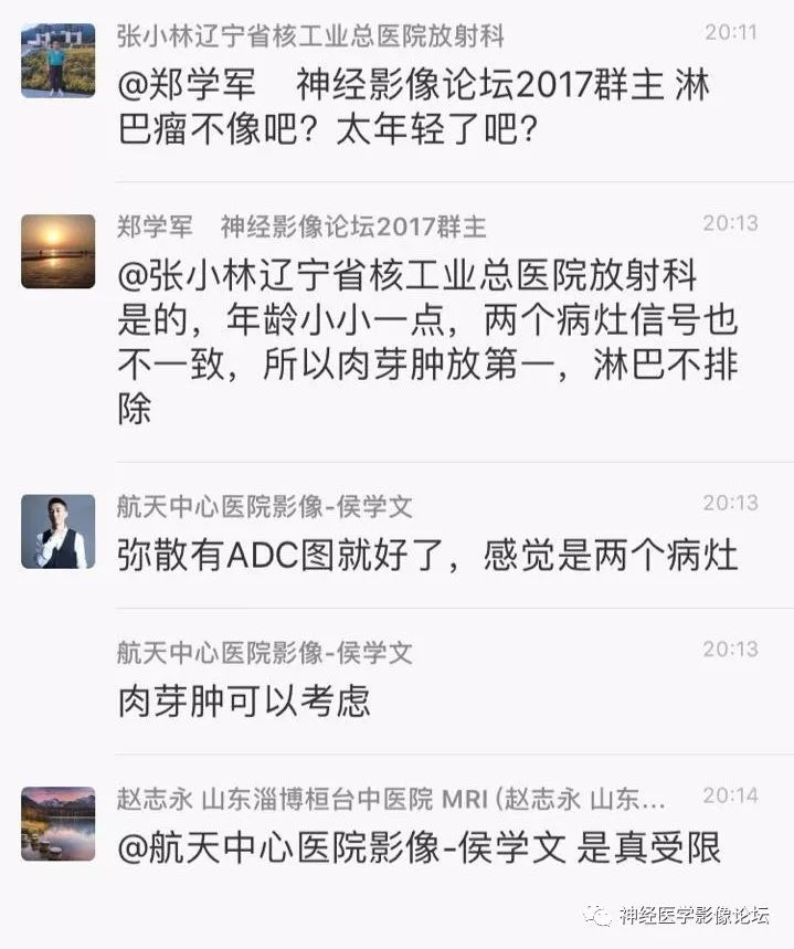 【病例】靠近脑表累及脑膜室管膜瘤1例MR
