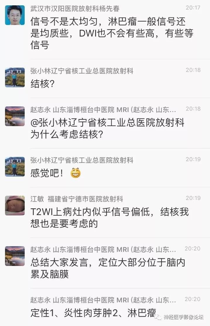 【病例】靠近脑表累及脑膜室管膜瘤1例MR