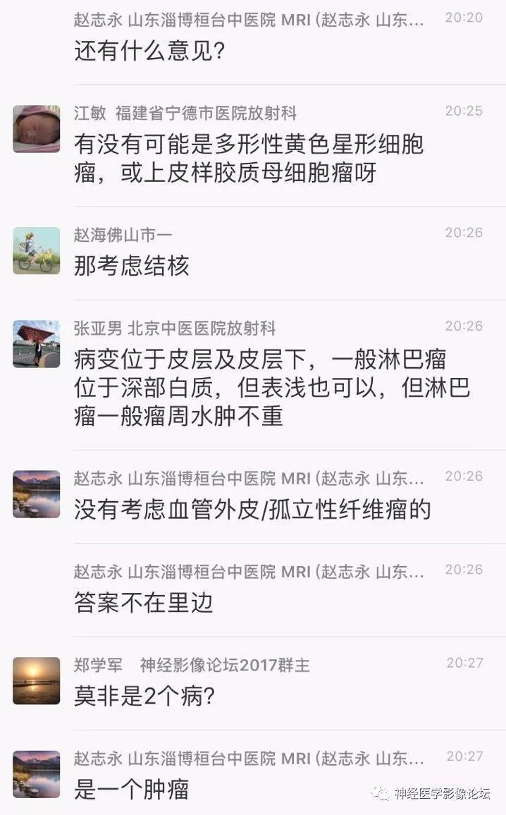 【病例】靠近脑表累及脑膜室管膜瘤1例MR