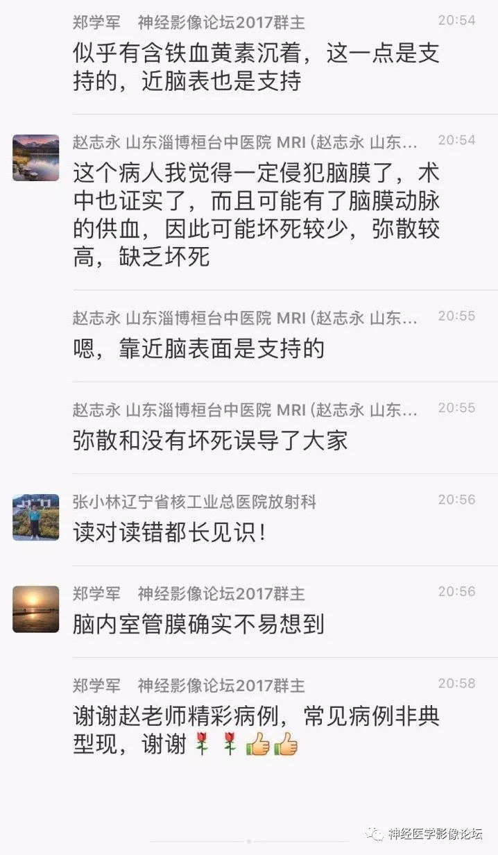 【病例】靠近脑表累及脑膜室管膜瘤1例MR