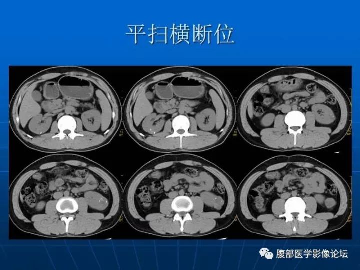 【病例】右肾混合性上皮和间质肿瘤1例CT 【病例】右肾混合性上皮和间质肿瘤1例CT