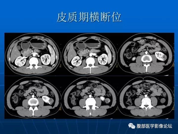 【病例】右肾混合性上皮和间质肿瘤1例CT 【病例】右肾混合性上皮和间质肿瘤1例CT