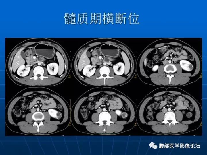 【病例】右肾混合性上皮和间质肿瘤1例CT 【病例】右肾混合性上皮和间质肿瘤1例CT