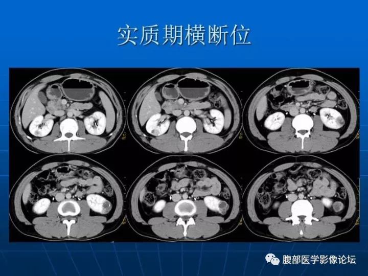【病例】右肾混合性上皮和间质肿瘤1例CT 【病例】右肾混合性上皮和间质肿瘤1例CT