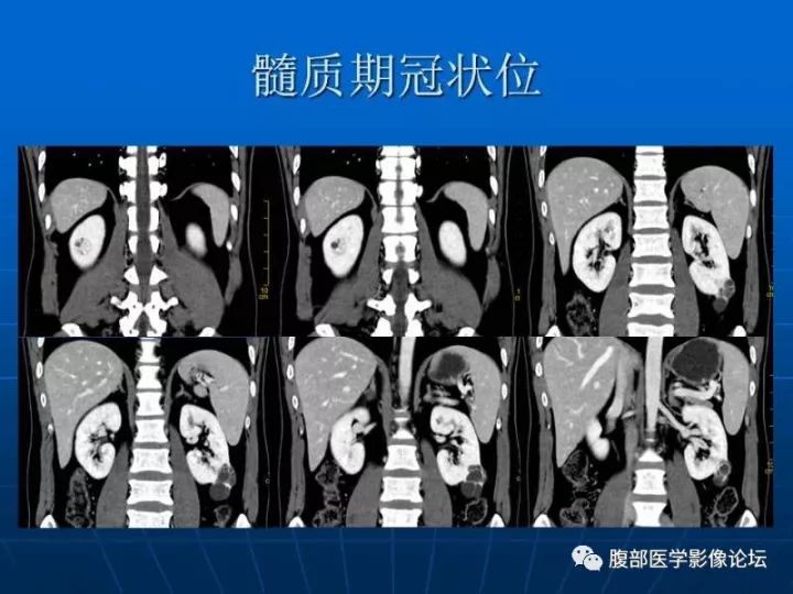 【病例】右肾混合性上皮和间质肿瘤1例CT 【病例】右肾混合性上皮和间质肿瘤1例CT