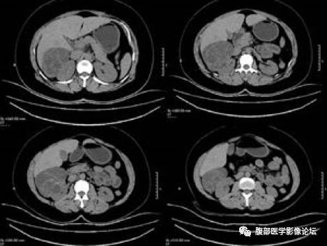 【病例】右肾混合性上皮和间质肿瘤1例CT 【病例】右肾混合性上皮和间质肿瘤1例CT