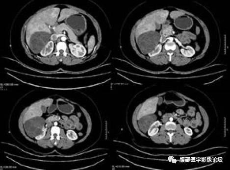 【病例】右肾混合性上皮和间质肿瘤1例CT 【病例】右肾混合性上皮和间质肿瘤1例CT