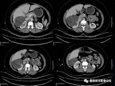 【病例】右肾混合性上皮和间质肿瘤1例CT 【病例】右肾混合性上皮和间质肿瘤1例CT