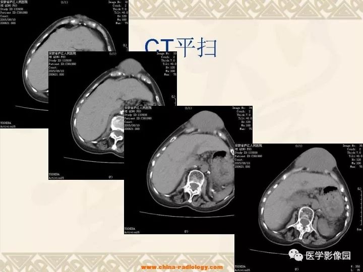 【病例】腹壁孤立性纤维瘤1例CT及MR影像表现 【病例】腹壁孤立性纤维瘤1例CT及MR影像表现