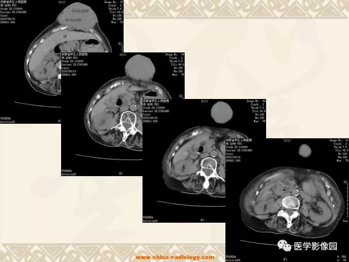 【病例】腹壁孤立性纤维瘤1例CT及MR影像表现 【病例】腹壁孤立性纤维瘤1例CT及MR影像表现