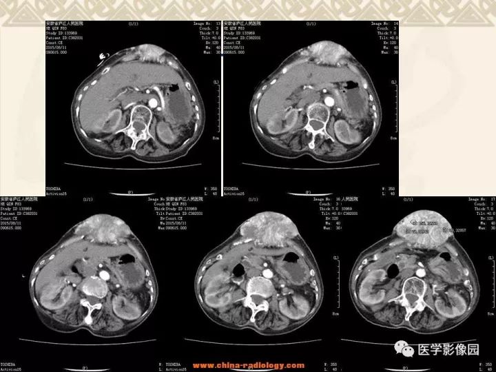 【病例】腹壁孤立性纤维瘤1例CT及MR影像表现 【病例】腹壁孤立性纤维瘤1例CT及MR影像表现