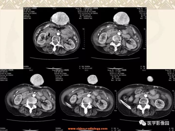 【病例】腹壁孤立性纤维瘤1例CT及MR影像表现 【病例】腹壁孤立性纤维瘤1例CT及MR影像表现