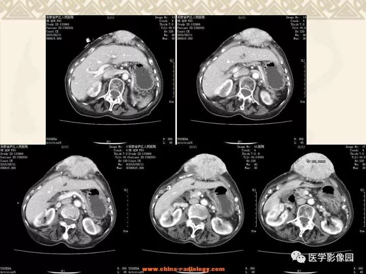 【病例】腹壁孤立性纤维瘤1例CT及MR影像表现 【病例】腹壁孤立性纤维瘤1例CT及MR影像表现