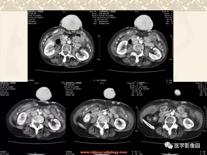 【病例】腹壁孤立性纤维瘤1例CT及MR影像表现 【病例】腹壁孤立性纤维瘤1例CT及MR影像表现