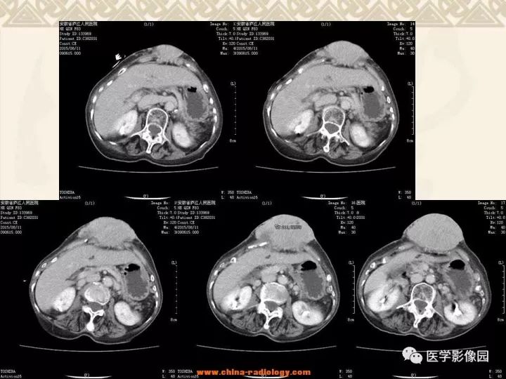 【病例】腹壁孤立性纤维瘤1例CT及MR影像表现 【病例】腹壁孤立性纤维瘤1例CT及MR影像表现
