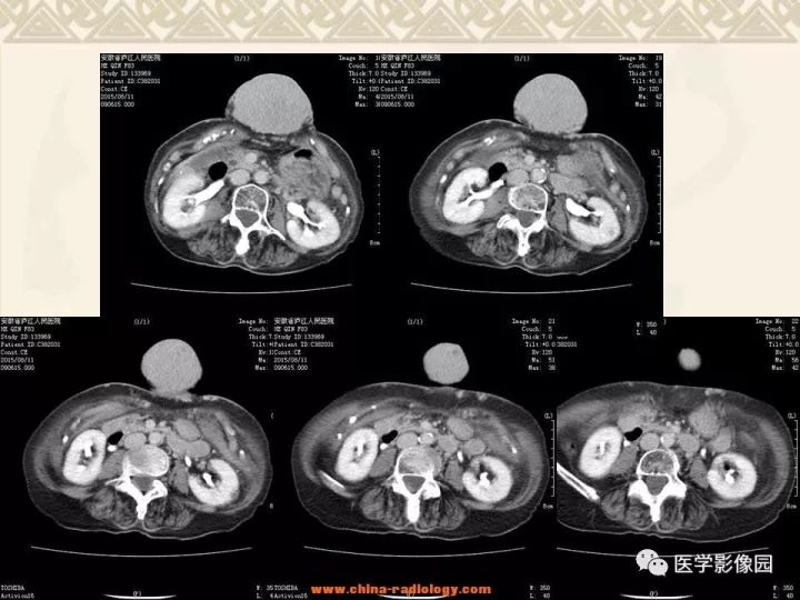 【病例】腹壁孤立性纤维瘤1例CT及MR影像表现 【病例】腹壁孤立性纤维瘤1例CT及MR影像表现
