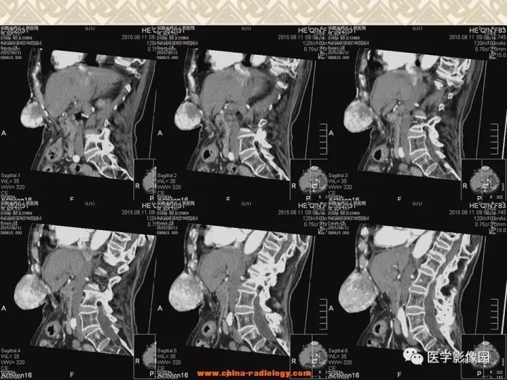 【病例】腹壁孤立性纤维瘤1例CT及MR影像表现 【病例】腹壁孤立性纤维瘤1例CT及MR影像表现