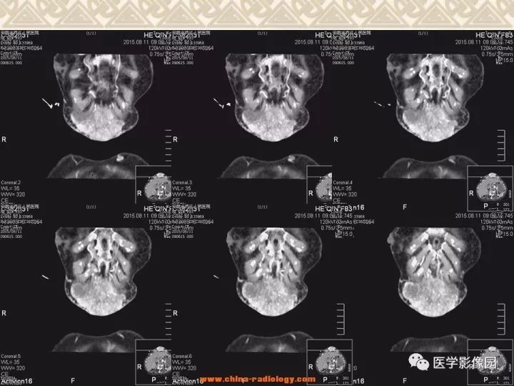【病例】腹壁孤立性纤维瘤1例CT及MR影像表现 【病例】腹壁孤立性纤维瘤1例CT及MR影像表现