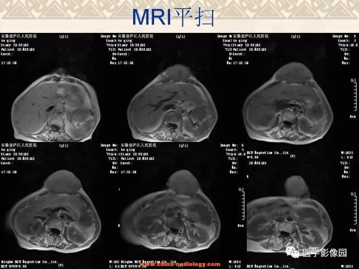 【病例】腹壁孤立性纤维瘤1例CT及MR影像表现 【病例】腹壁孤立性纤维瘤1例CT及MR影像表现
