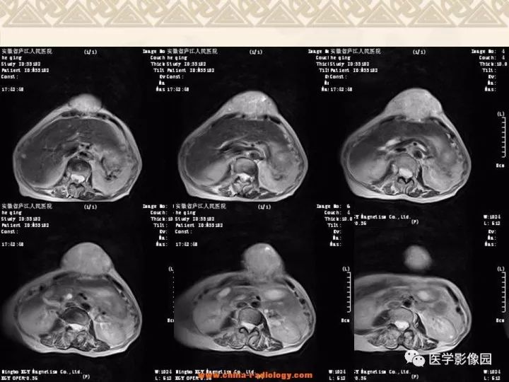【病例】腹壁孤立性纤维瘤1例CT及MR影像表现