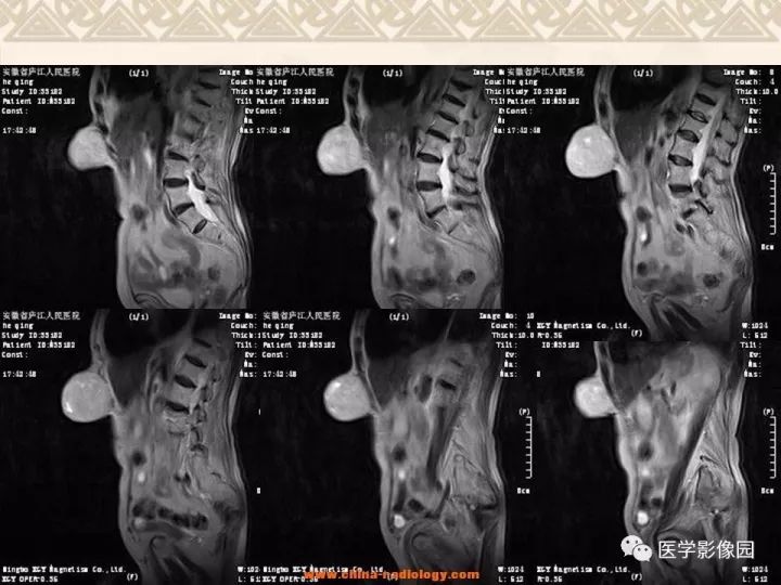【病例】腹壁孤立性纤维瘤1例CT及MR影像表现 【病例】腹壁孤立性纤维瘤1例CT及MR影像表现