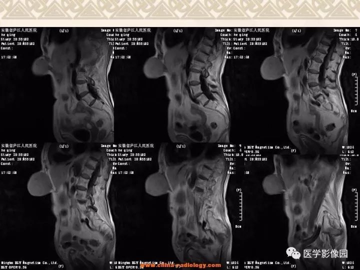 【病例】腹壁孤立性纤维瘤1例CT及MR影像表现 【病例】腹壁孤立性纤维瘤1例CT及MR影像表现