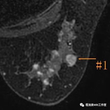 怎样理解BI-RADS 4类病灶 怎样理解BI-RADS 4类病灶