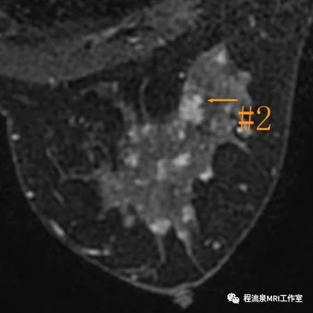 怎样理解BI-RADS 4类病灶 怎样理解BI-RADS 4类病灶