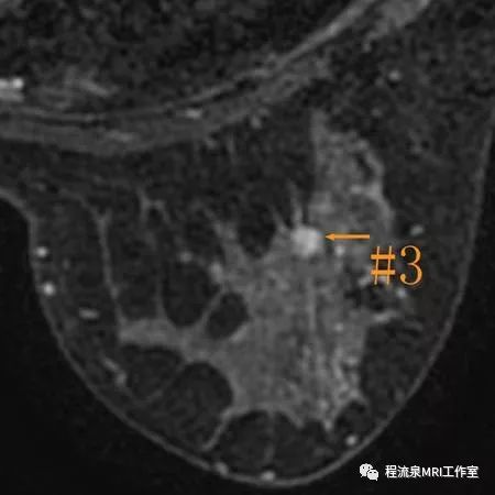 怎样理解BI-RADS 4类病灶 怎样理解BI-RADS 4类病灶