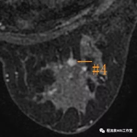 怎样理解BI-RADS 4类病灶 怎样理解BI-RADS 4类病灶