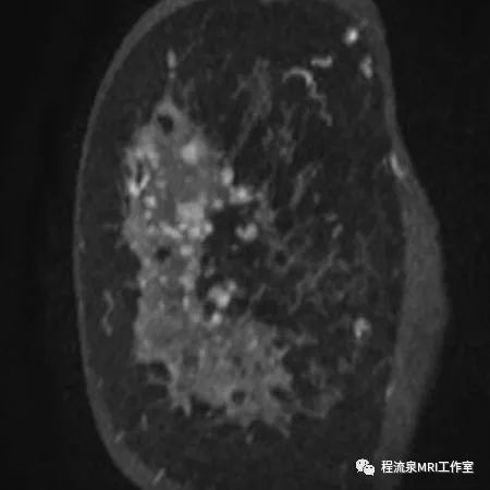 怎样理解BI-RADS 4类病灶 怎样理解BI-RADS 4类病灶
