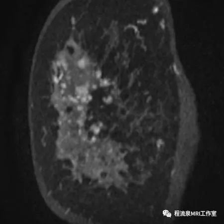 怎样理解BI-RADS 4类病灶 怎样理解BI-RADS 4类病灶