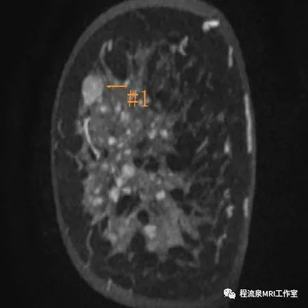 怎样理解BI-RADS 4类病灶