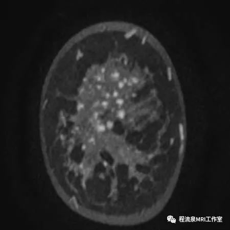 怎样理解BI-RADS 4类病灶 怎样理解BI-RADS 4类病灶