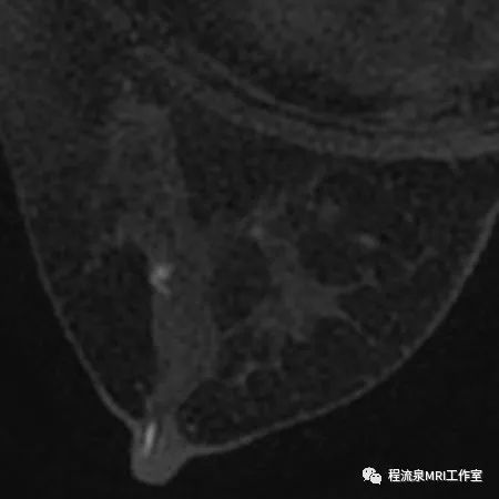 怎样理解BI-RADS 4类病灶 怎样理解BI-RADS 4类病灶