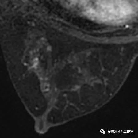 怎样理解BI-RADS 4类病灶 怎样理解BI-RADS 4类病灶