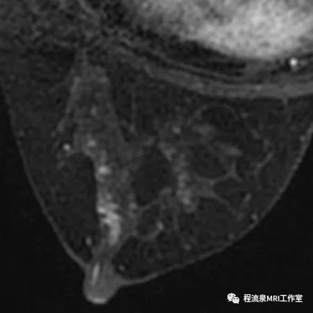 怎样理解BI-RADS 4类病灶 怎样理解BI-RADS 4类病灶