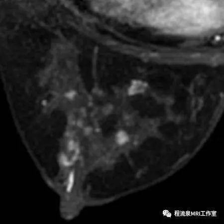 怎样理解BI-RADS 4类病灶 怎样理解BI-RADS 4类病灶
