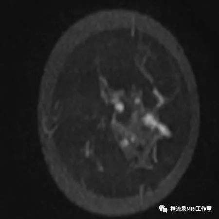 怎样理解BI-RADS 4类病灶 怎样理解BI-RADS 4类病灶